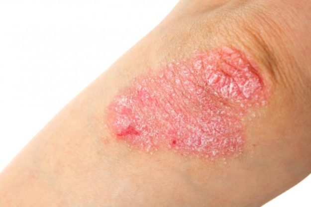 psoriasis-on-an-elbow