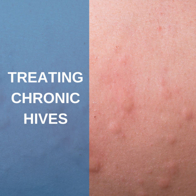 Treating Chronic Hives