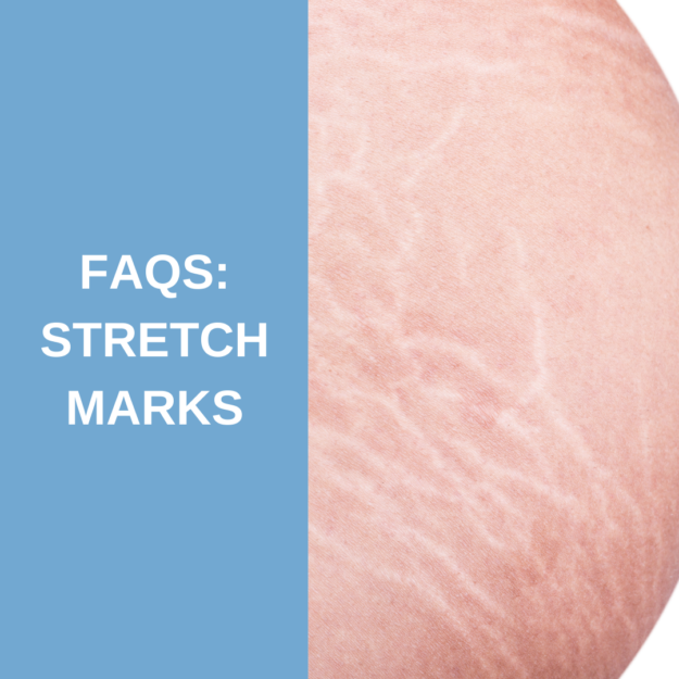 Stretch Marks