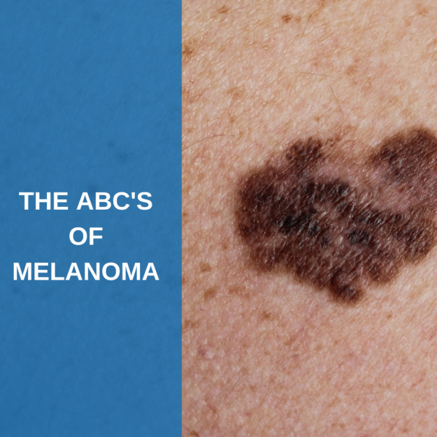 The ABC’s of Melanoma