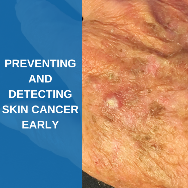 Preventing and Detecting Skin Cancer