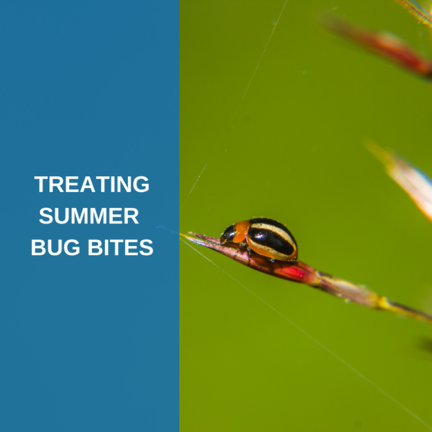 Treating Summer Bug Bites