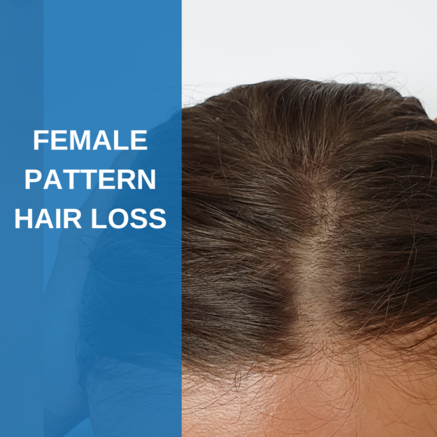 Female Pattern Hair Loss