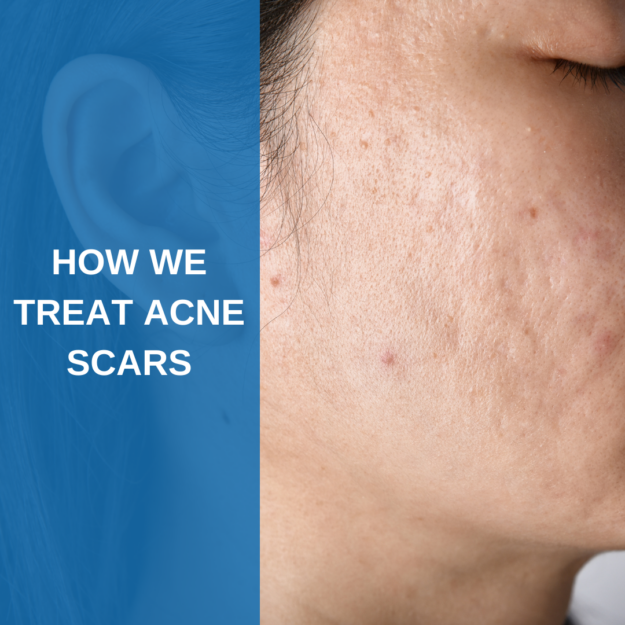 How we treat acne scars Acne Scars