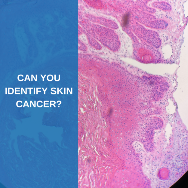 identifying skin cancer