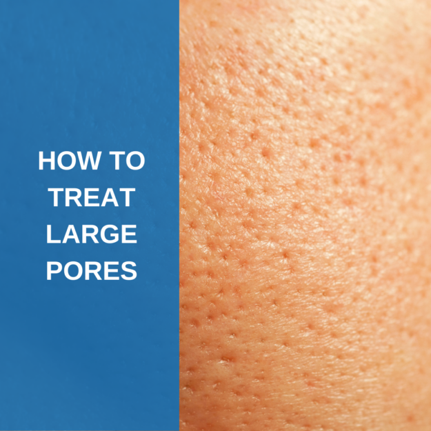 How to reduce the appearance of large pores
