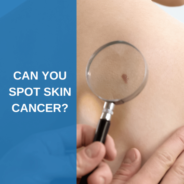 Can you spot skin cancer