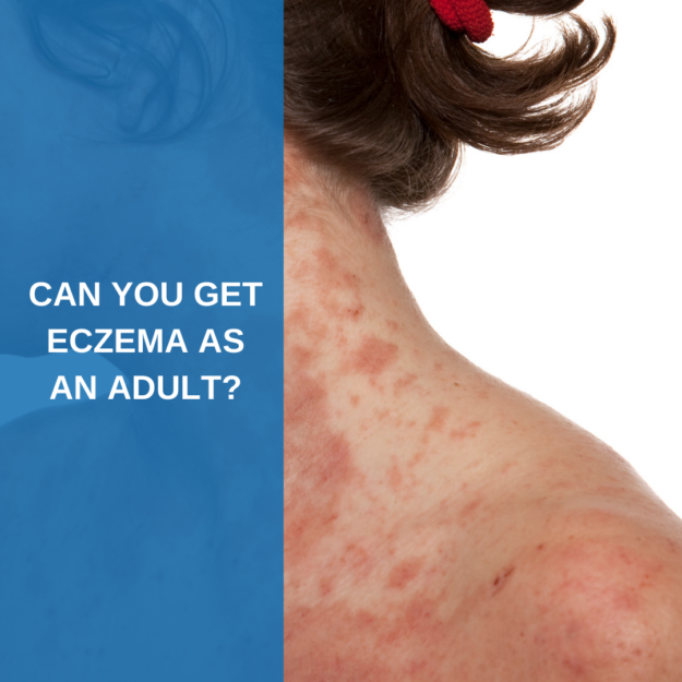 Can you get eczema as an adult?