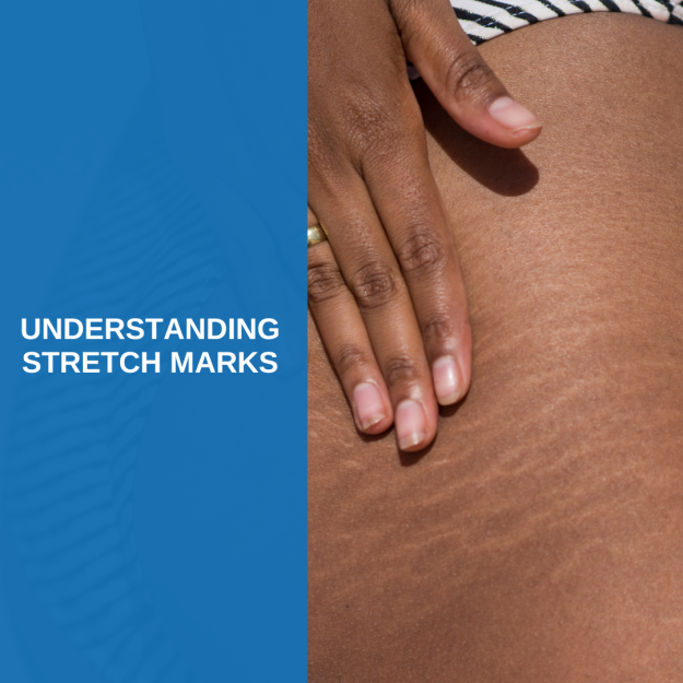 Understanding stretch marks