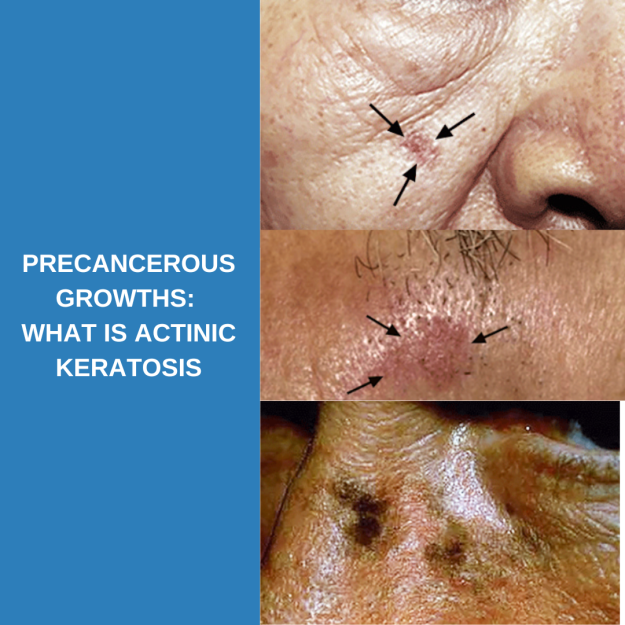 actinic keratosis