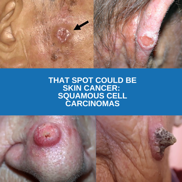 That spot could be skin cancer