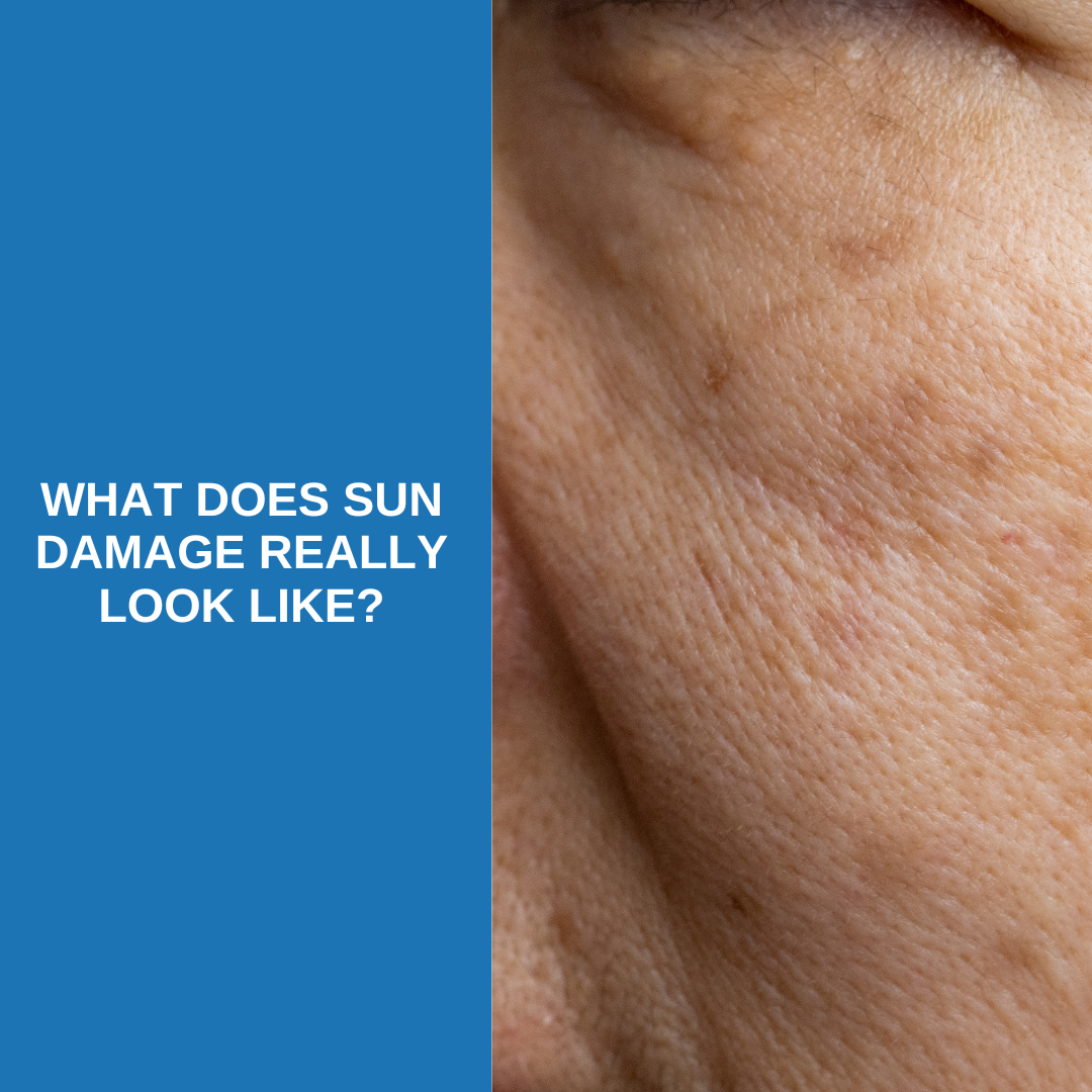 what sun damage actually looks like
